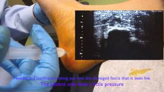 Ultrasound Guided Plantar Fascia Injection [upl. by Ekim547]