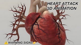 Recognizing a heart attack  3D Animation [upl. by Eiramait]