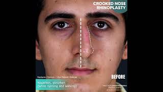 Crooked Nose Surgery Transformation Journey [upl. by Alfi]