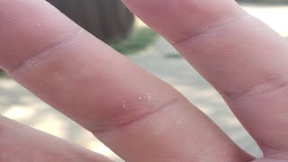 how to get rid of a splinter inside your skin easy [upl. by Marigolda]