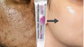 SkinLite Cream  remove pigmentation dark spots Acne marks pimple marks [upl. by Sewellyn451]