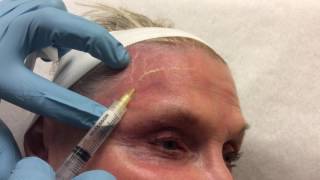 Face Sclerotherapy Video [upl. by Crystie]