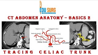 CT abdomen interpretation  celiac axis [upl. by Severson]