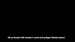 Reinke edema vocal cord polyps and how they effect voice [upl. by Oneill366]