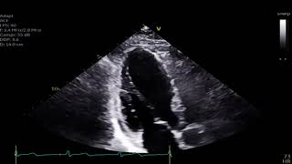 Mid Wall Stress Cardiomyopathy [upl. by Missak]