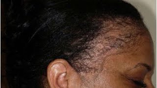 How to know if your Alopecia is reversible  Can I regrow my hair after Alopecia [upl. by Cohla]