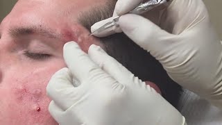 Super Satisfying Blackhead Removal [upl. by Falda973]