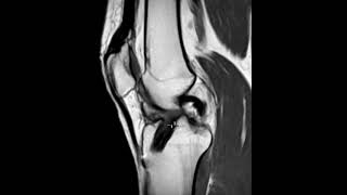 Arthrofibrosis cyclops lesion in knee after ACL repair [upl. by Uile]