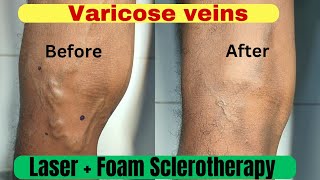 Varicose veins treatment  3 month follow up result Laser treatment  Foam Sclerotherapy treatment [upl. by Reyem]