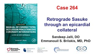 Case 264 Manual of CTO PCI Retrograde Sasuke through an epicardial collateral [upl. by Serena975]