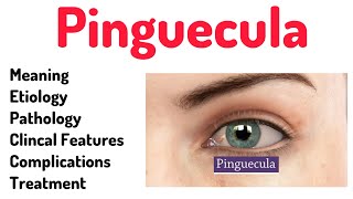 Pinguecula Conjunctival Anomalypinguecula eyes optometrists optometry [upl. by Nydnarb]