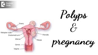 Do polyps stop you getting pregnant amp its management  Dr Rashmi Yogish [upl. by Yllod248]