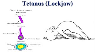 Tetanus The Deadly Consequences of Neglected Wound Infections  Lockjaw  Tetanospasmin [upl. by Nesaj]