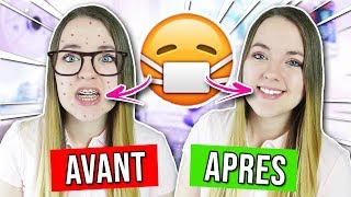 AVOIR UN APPAREIL DENTAIRE  AVANT VS APRES [upl. by Wil]