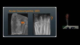 Imaging of Osteomyelitis amp Septic Arthritis  15 Minute Radiology CME [upl. by Simmie]