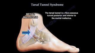 Tarsal Tunnel Syndrome causes and treatment [upl. by Bethezel86]