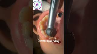 Central incisor cosmetic filling dentist dentalclinic toothdental [upl. by Osbert]