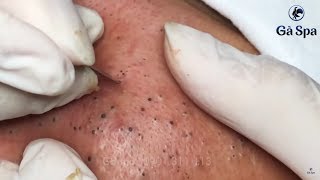 Best Blackhead Removal Ever 55min  Facial Acne Treatment  Gà Spa [upl. by Nnaeirual61]