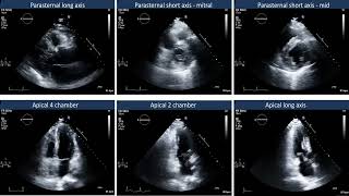 TTE Acute RCA infarct [upl. by Enawtna243]