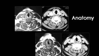 Radiology  Imaging of Larynx  Head and Neck [upl. by Enelak]