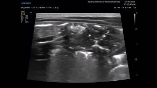 Necrotizing enterocolitis NEC [upl. by Sachs394]