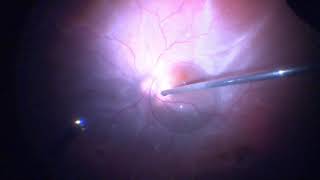 Surgery Vitrectomy for Retinal Detachment Assortment of Cases [upl. by Sankaran169]