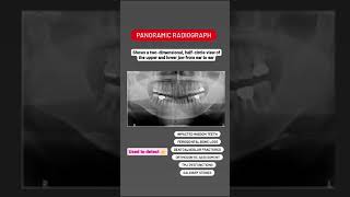 What is OPG or Orthopantomogram X ray [upl. by Aloz]