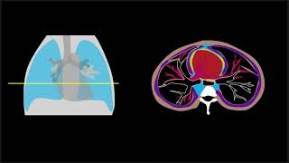 Pneumomediastinum Explained by Prometheus Lionhart MD [upl. by Uase767]