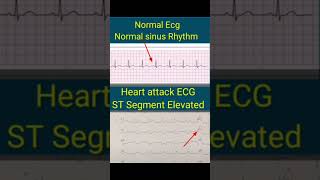 HEART ATTACK on ECG VS NORMAL ECG  You wont believe [upl. by Harli68]