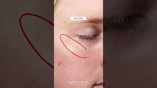 Before and After IPL Laser LUMECCA Kami Parsa MD  PARSA MD skincare [upl. by Kalle]