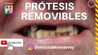 ⏩Los Cambios que una PRÓTESIS REMOVIBLE puede Lograr 👅 ProtesisRemovibles PPR [upl. by Ultun335]