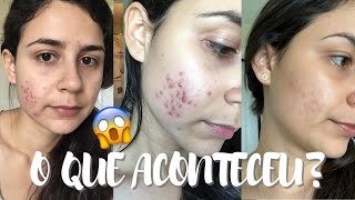 COMO EU TRATEI MINHA ACNE NO ROSTO  PRODUTOS QUE MUDARAM MINHA PELE COM ACNE espinhas [upl. by Hairahs]