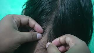 Lice Infested Catching and Popping Sounds  ASMR Lice Picking In My Head [upl. by Heimlich94]