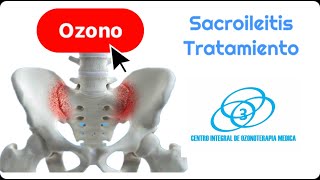 Sacroileitis en la Discartrosis Lumbar tratamiento [upl. by Orecic]