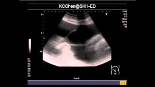 Sclerosing Encapsulating Peritonitis [upl. by Cerelly]