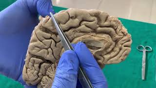 Dissection Sulci amp Gyri on Medial surface of brain [upl. by Ahtivak]