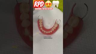 RPD ‼️ Removable partial denture  best dentist in delhi BeingDental dentistry shorts video yt [upl. by Llennahs773]