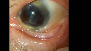 Ocular Cicatricial Pemphigoid [upl. by Trainer]