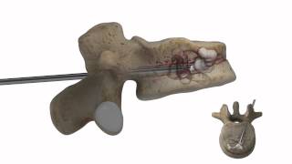 Augmenta Vertebral Augmentation Device [upl. by Elatsyrk]