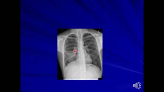 Suppurative lung diseases [upl. by Xaviera]