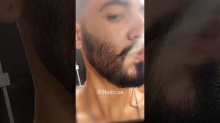 1 ANO USANDO MINOXIDIL evolução minoxidil minoxidil barba [upl. by Buck]