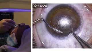 London Vision Clinic  ReLEx SMILE  Live laser eye surgery  Professor Dan Reinstein [upl. by Nevart]