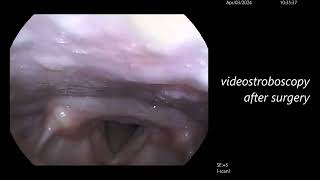 Reinkes Oedema of The Vocal Cords Causing Hoarse Voice [upl. by Lasonde]