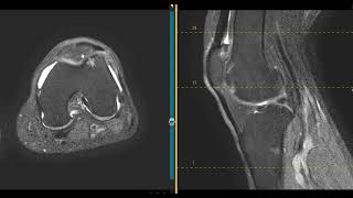 Knee pain in 63 year old grandmother [upl. by Nonnad]