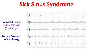 Sick Sinus Syndrome [upl. by Leoy]