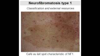 Neurofibromatosis Type 1 von Recklinghausens Disease [upl. by Inahpets176]