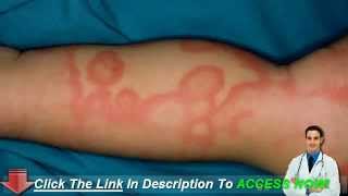 Home Remedy For Hives  The Best Way to Quickly Resolve it Naturally [upl. by Amarette]