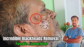 7YearOld Giant Blackhead Extraction Needle Method Revealed  alliedhealthscience skincare [upl. by Hsevahb768]