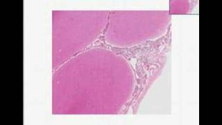 Histopathology Brain Acute pyogenic bacterial meningitis [upl. by Akcirederf102]