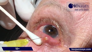 Eye Stye Removal at Benjamin Eye Institute [upl. by Anahahs]